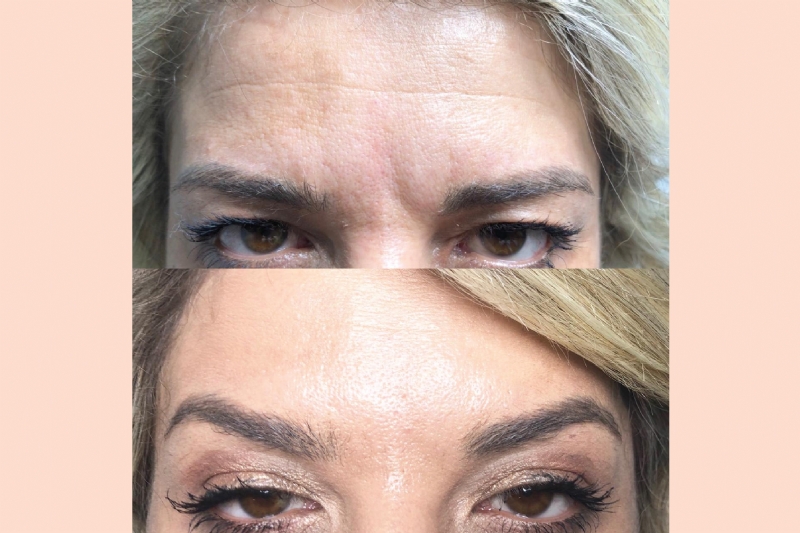 Klinika Venus Center, mbushje rrudhash me Acid Hyalurinik dhe Botox, Laser Smooth Beam dhe CO2, Skleroterapi, Heqje Rrudhash me Botox, Piling Kimik, Injeksion me Plazem, Mikrodermoabrazion, Sonoforeze, Ultrasaund